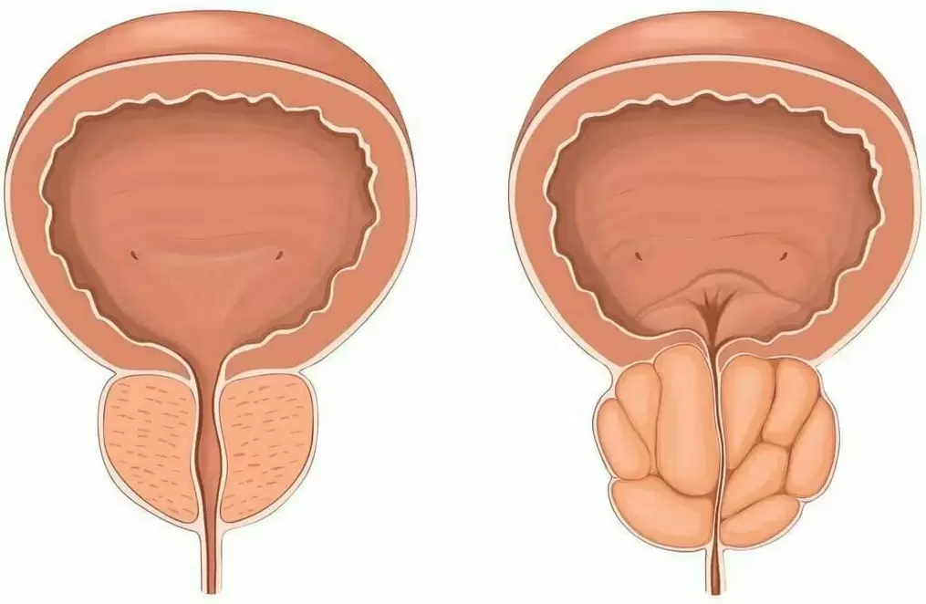 próstata normal e próstata doente