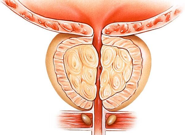 ilustração de próstata inflamada